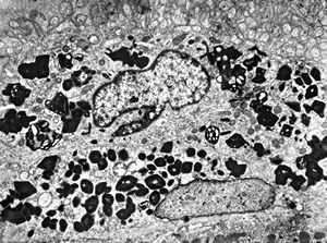 M,58y. | crystalline inclusions in hepatocyte after unknown medication M,58y. | crystalline inclusions in hepatocyte after unknown medication